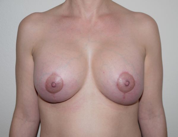 After Image: Breast Lift with Augmentation - front