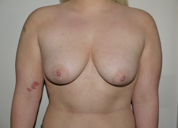 Before Image: Breast Lift with Augmentation - front