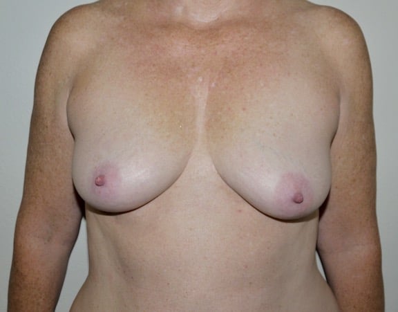 Before Image: Breast Augmentation - front