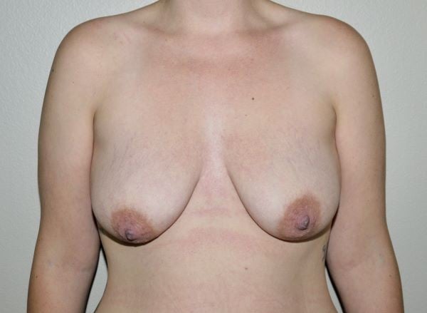 Before Image: Breast Lift with Augmentation - front