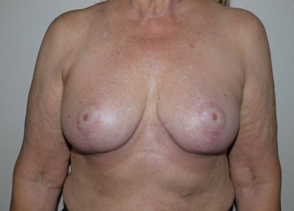 After Image: Breast Implant Removal with Lift - front