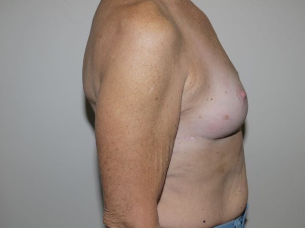 After Image: Breast Implant Removal with Lift - right-side