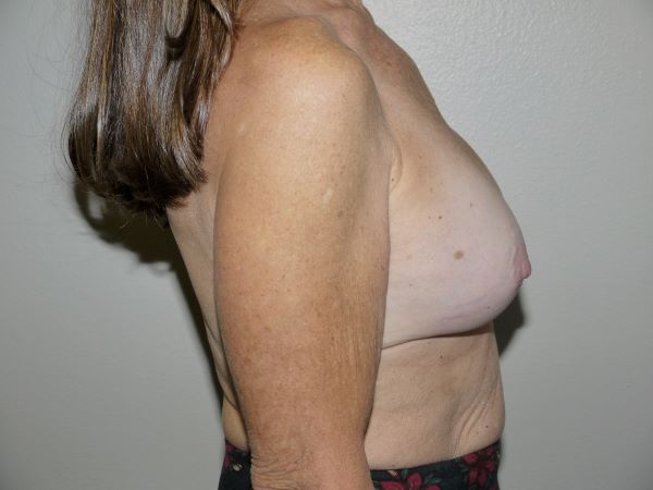 Before Image: Breast Implant Removal with Lift - right-side