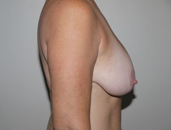 Before Image: Breast Lift - right-side