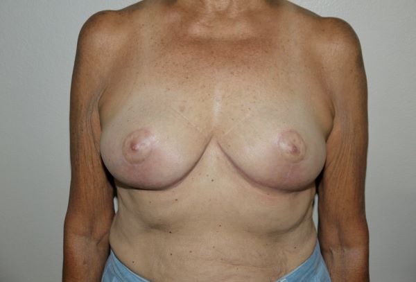 After Image: Breast Implant Removal with Lift - front
