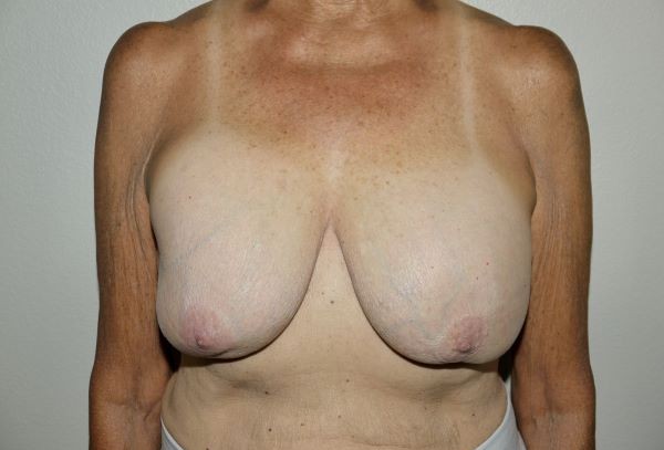 Before Image: Breast Implant Removal with Lift - front