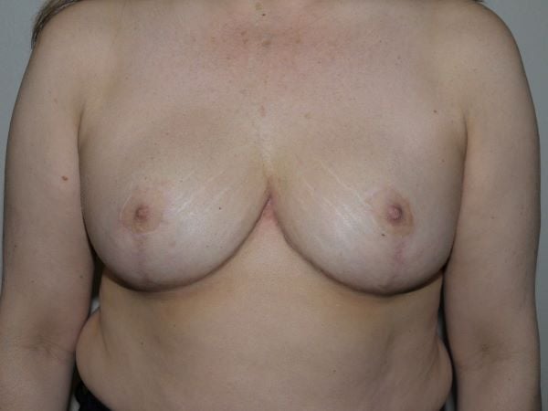 After Image: Breast Implant Removal with Lift - front