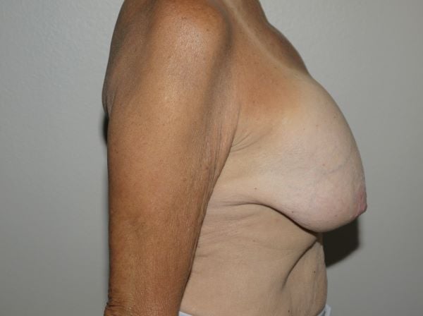Before Image: Breast Implant Removal with Lift - right-side