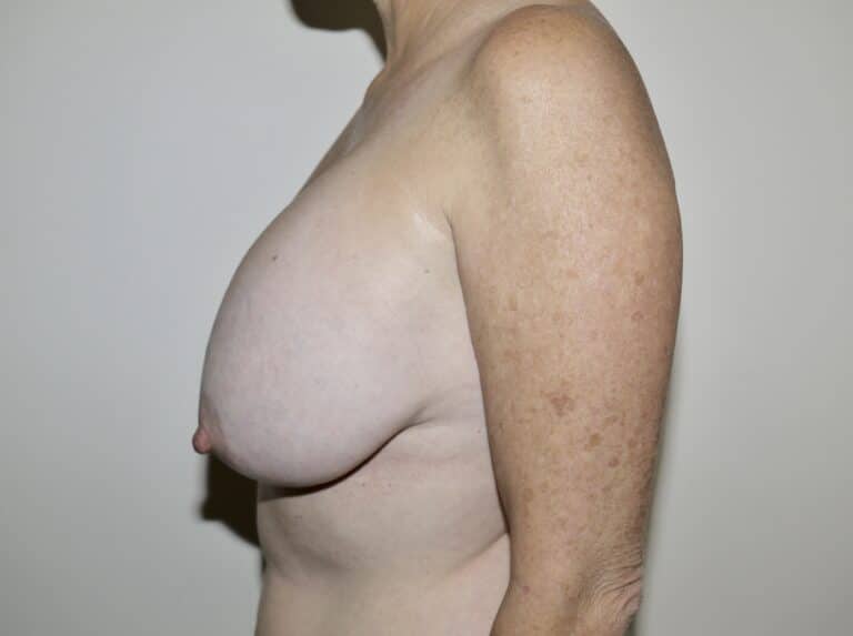 Before Image: Breast Implant Removal with Lift - left-side