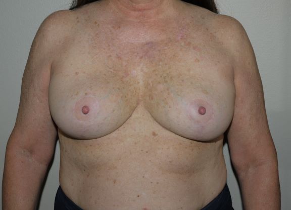 After Image: Breast Implant Removal with Lift - front