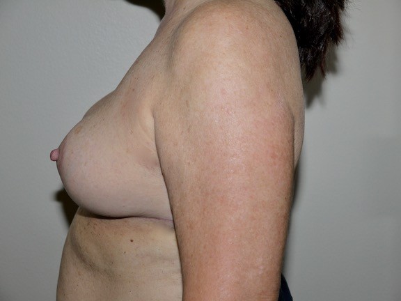 After Image: Breast Implant Removal with Lift - left-side