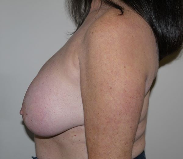 Before Image: Breast Implant Removal with Lift - left-side