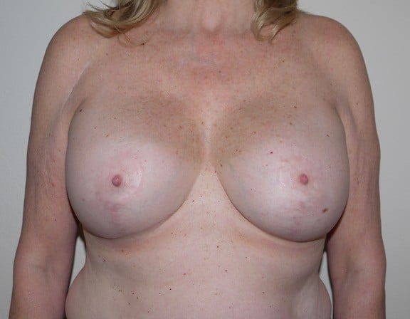 After Image: Breast Lift with Augmentation - front