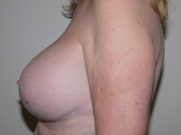 After Image: Breast Lift with Augmentation - left-side
