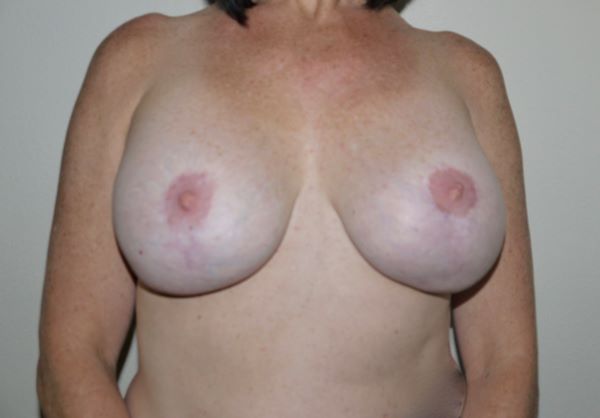 Before Image: Breast Implant Removal with Lift - front