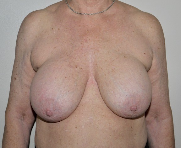 Before Image: Breast Implant Removal with Lift - front