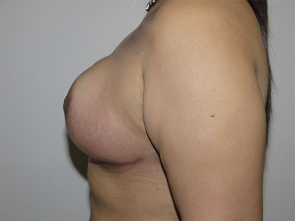 After Image: Breast Reduction - left-side
