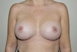 Breast Implant Revision