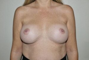 Breast Implant Revision