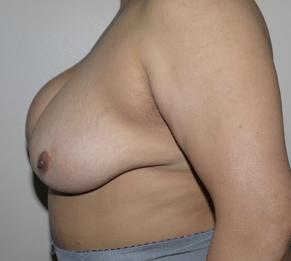 Before Image: Breast Implant Removal with Lift - left-side