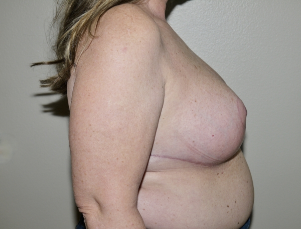 After Image: Breast Implant Removal with Lift - right-side