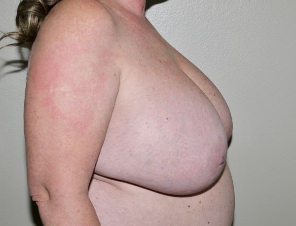 Before Image: Breast Implant Removal with Lift - right-side