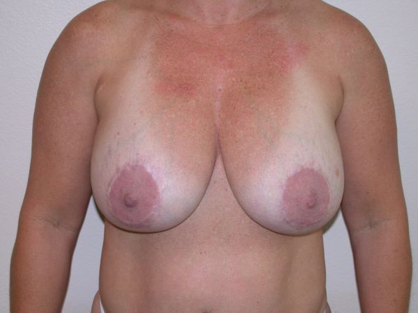 Before Image: Breast Implant Removal with Lift - front