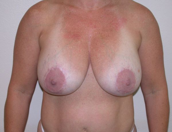 Before Image: Breast Implant Removal with Lift - front