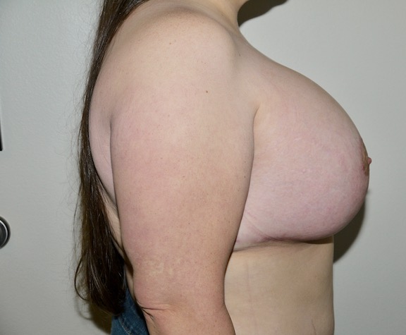 After Image: Breast Lift with Augmentation - right-side