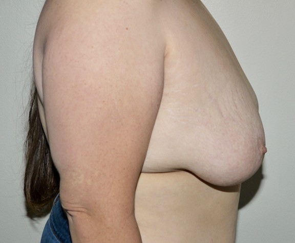 Before Image: Breast Lift with Augmentation - right-side
