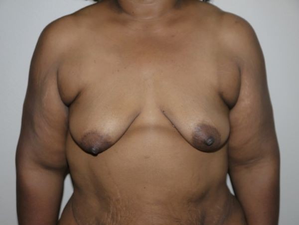 Before Image: Breast Lift with Augmentation - front