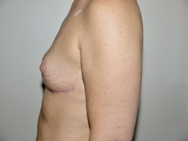 After Image: Breast Implant Removal with Lift - left-side