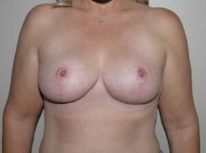 Breast Reduction