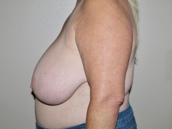 Before Image: Breast Reduction - left-side