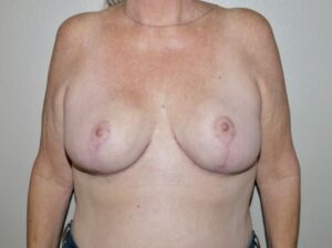 Breast Reduction