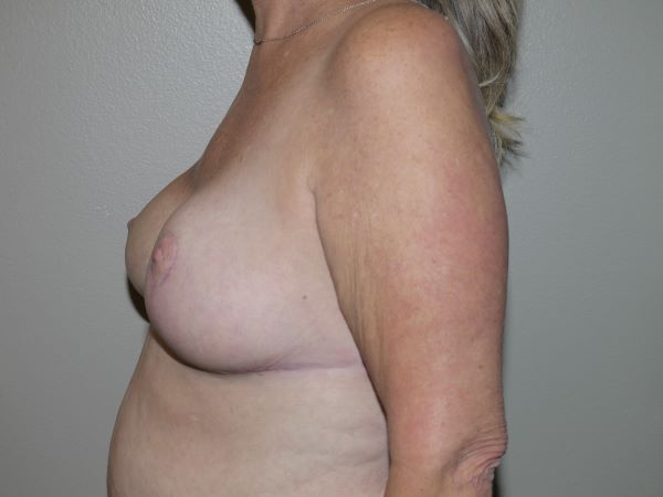 After Image: Breast Reduction - left-side