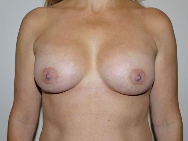 After Image: Breast Augmentation - front