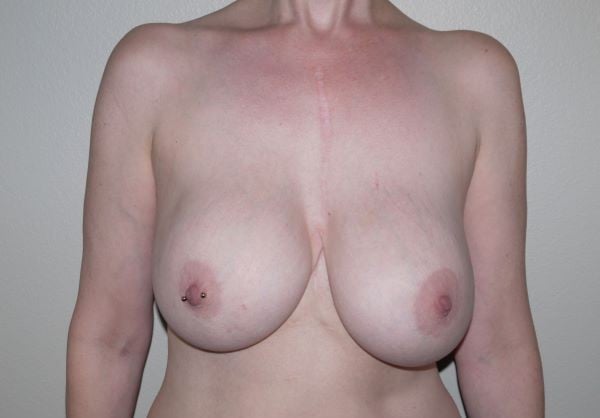 Before Image: Breast Implant Removal with Lift - front