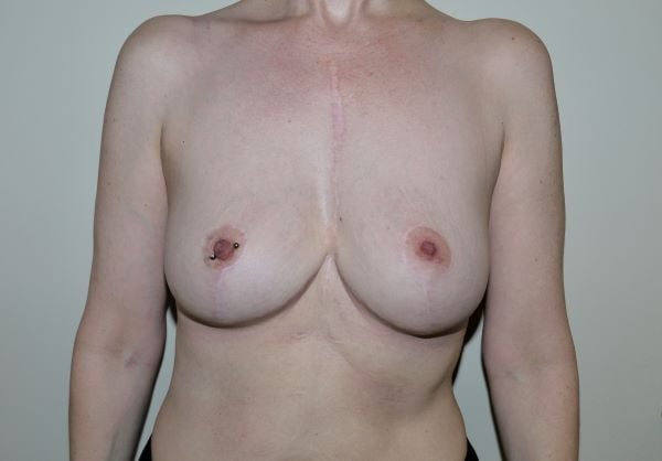 After Image: Breast Implant Removal with Lift - front