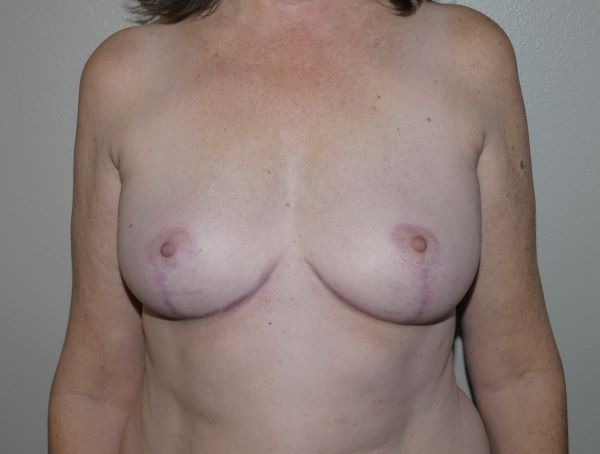 After Image: Breast Implant Removal with Lift - front