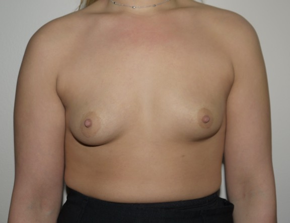 Before Image: Breast Augmentation - front