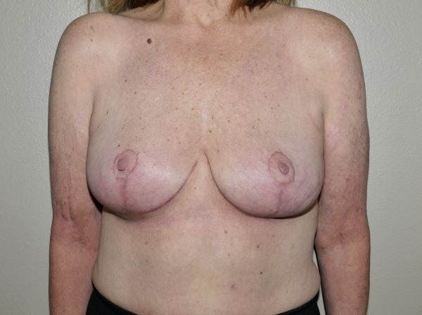 After Image: Breast Implant Removal with Lift - front