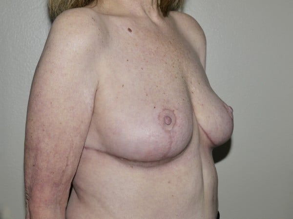 After Image: Breast Implant Removal with Lift - right-front-oblique