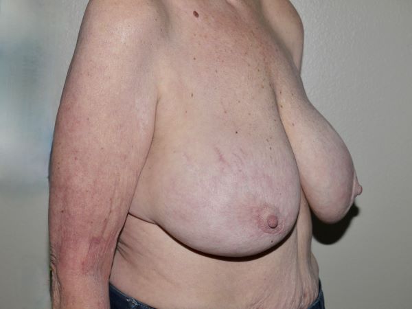 Before Image: Breast Implant Removal with Lift - right-front-oblique