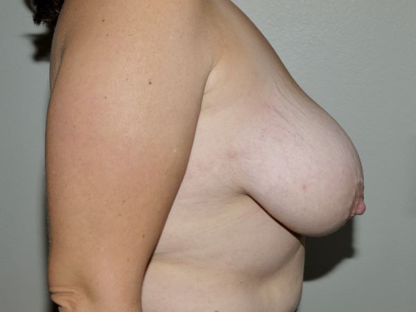 Before Image: Breast Reduction - right-side