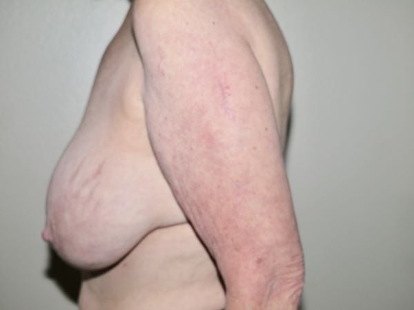 Before Image: Breast Implant Removal with Lift - left-side