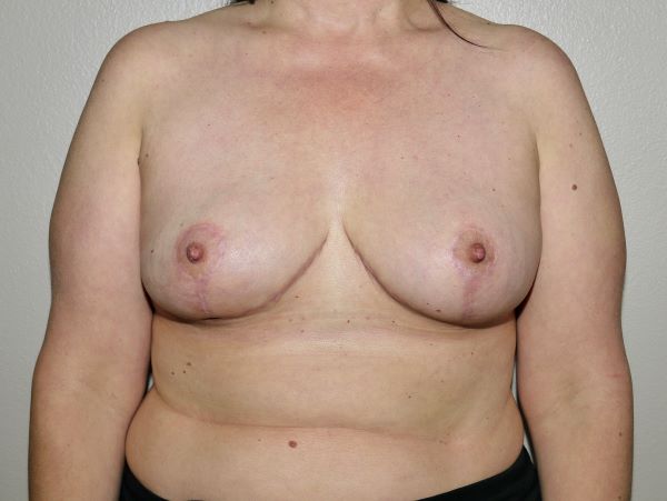 After Image: Breast Implant Removal with Lift - front