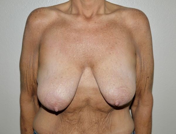 Before Image: Breast Lift with Augmentation - front