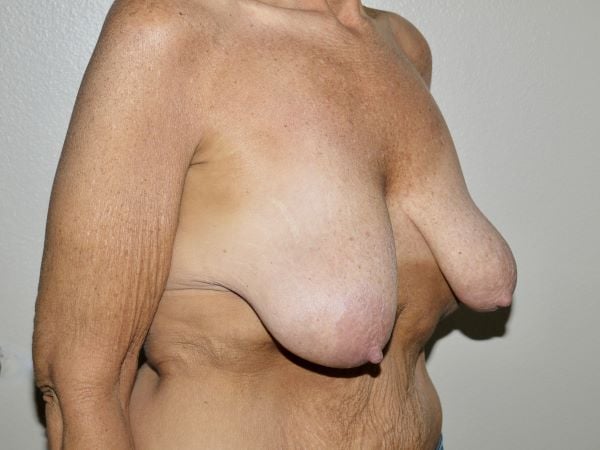 Before Image: Breast Lift with Augmentation - right-front-oblique