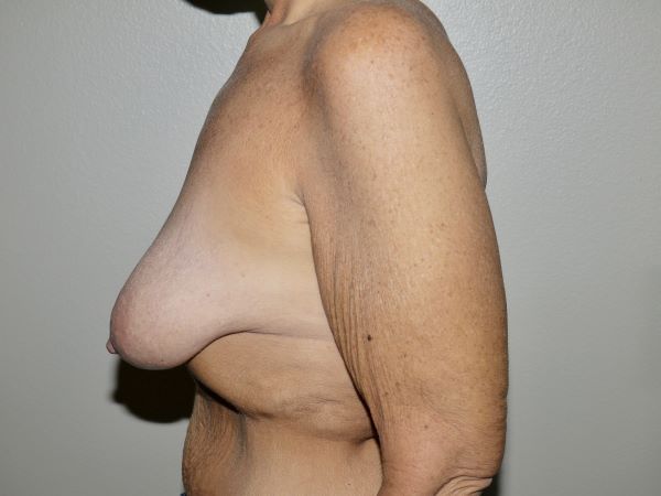 Before Image: Breast Lift with Augmentation - left-side